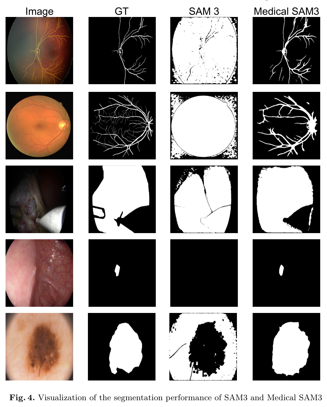Visualization of the segmentation performance of SAM and Medical SAM3