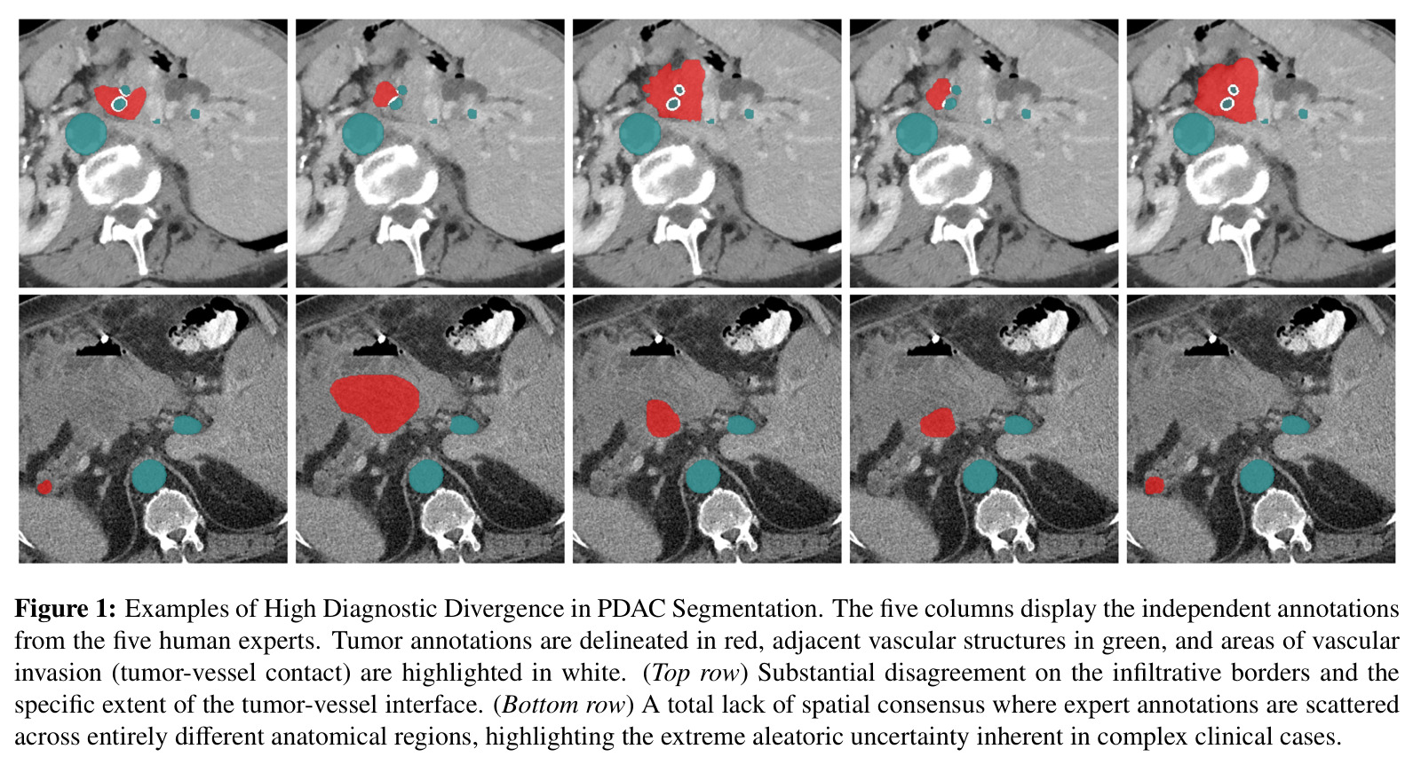 Examples of High Diagnostic Divergence in PDAC Segmentation