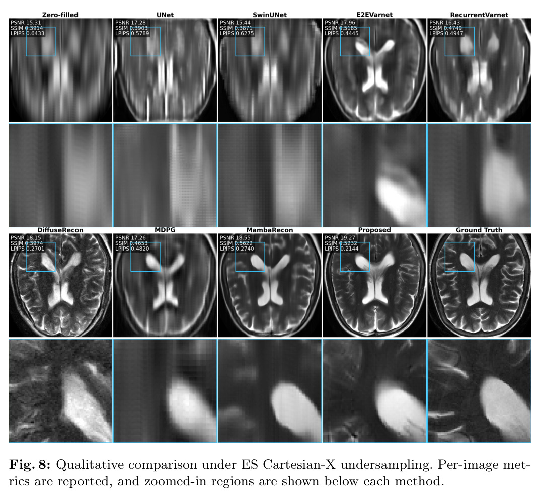 Qualitative comparison under ES Cartesian-X undersampling
