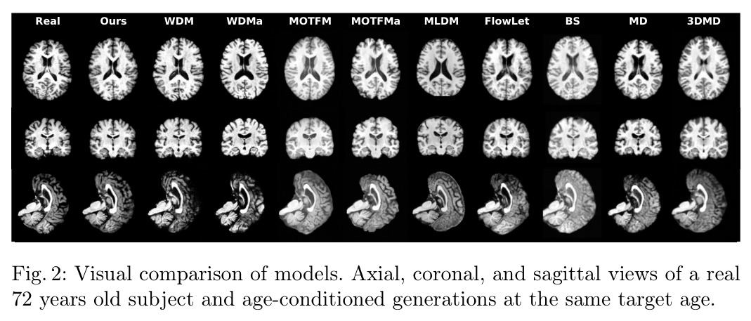Visual comparison of models. Axial, coronal, and sagittal views of a real 72 years old subject and age-conditioned generations at the same target age.